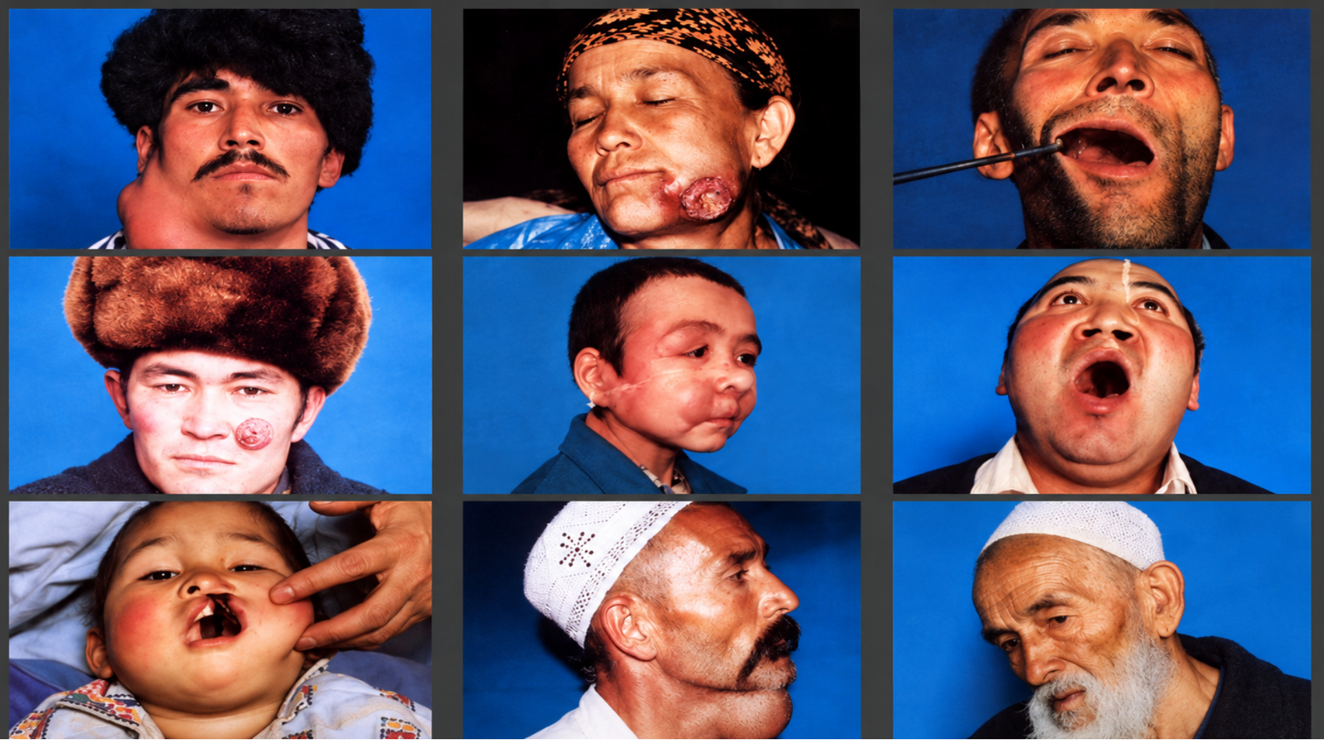 Uyghur communities affected by the legacy of nuclear testing at Lop Nur